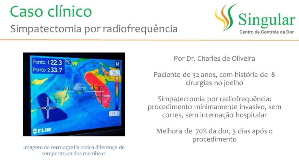 Caso clínico: simpatectomia por radiofrequência