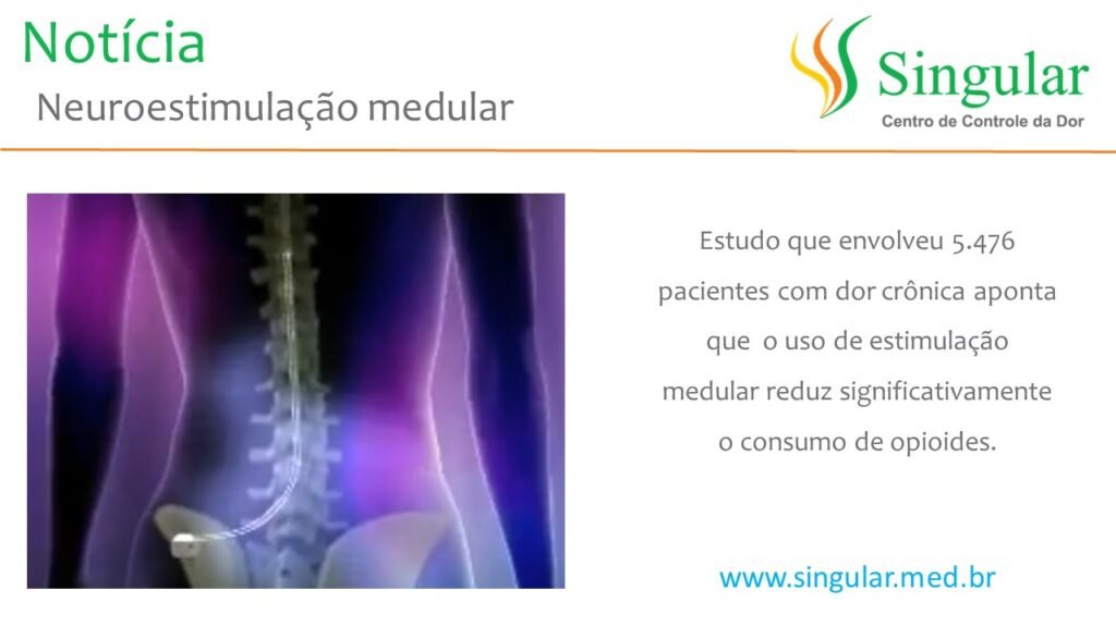 Estimulação medular reduz uso de opoides, diz estudo