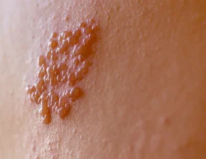 Tratamento para herpes zoster: como funciona e quando buscar ajuda