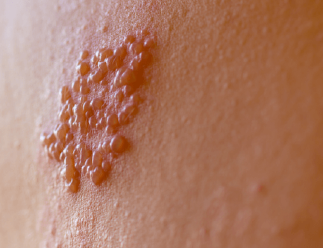 Tratamento para herpes zoster: como funciona e quando buscar ajuda