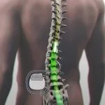 Estimulação medular